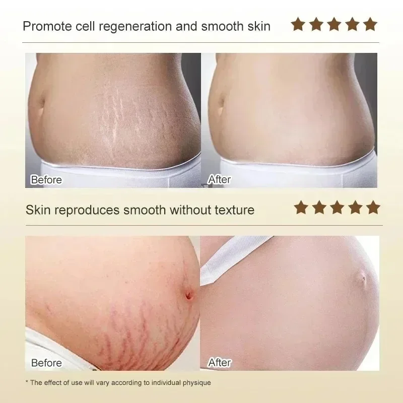 ストレッチマーク永久除去クリーム 体の腹部のストレッチマーク - Skincare Oat のレビューと価格